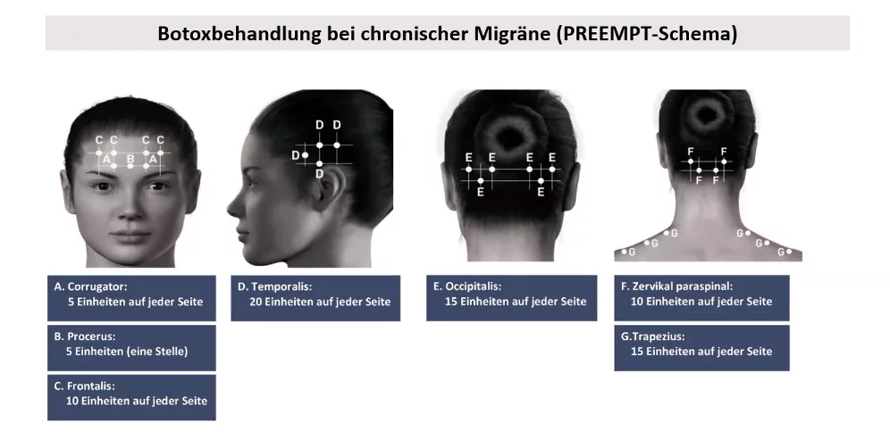 Botox gegen Migräne Botox gegen Migräne